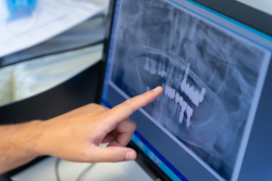 radiographie-numerique-dentaire-dentiste-paris-13