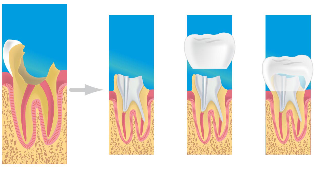 prothese dentaire paris 13