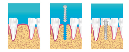 Implants dentiste Paris 13